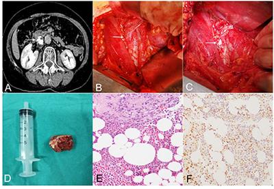 Heterotopic Ossification of the Inferior Vena Cava Wall: A Case Report and Literature Review